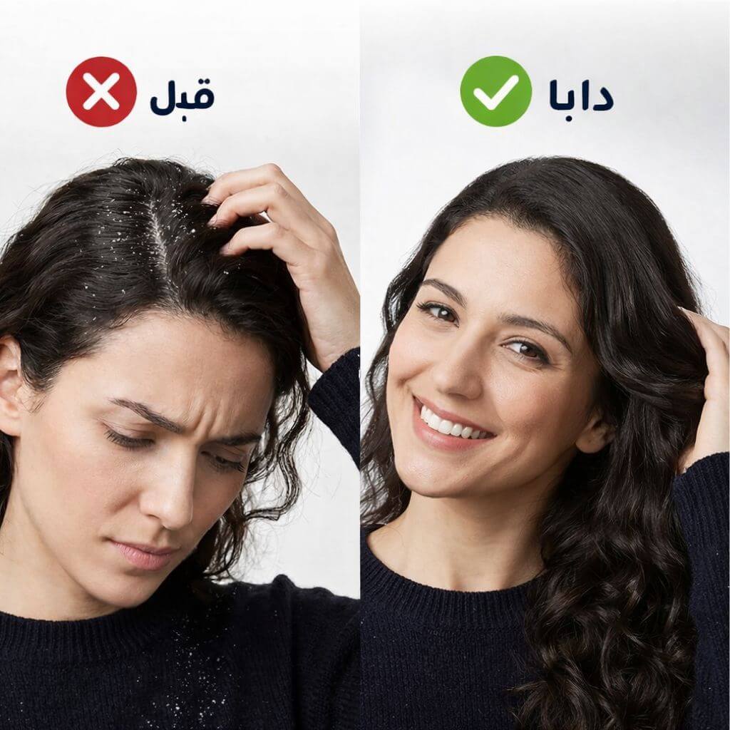 مشكلة القشرة